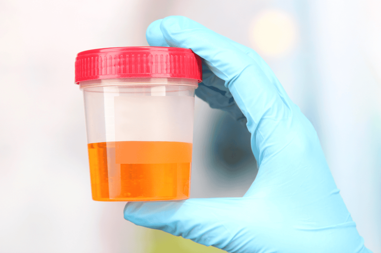 Urine sample in a transparent container with a red lid, held by a gloved hand, used for medical testing and analysis at The Solemn Sir.